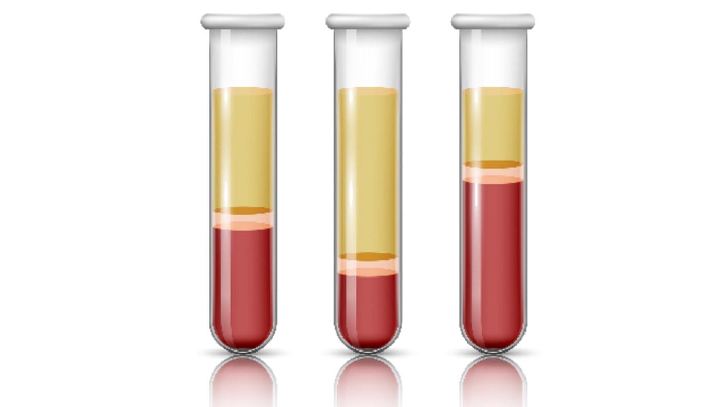 Illustration of three test tubes filled with blood separated into layers of plasma, buffy coat, and red blood cells. The three tubes show the components of normal blood, anemia, and polycythemia.