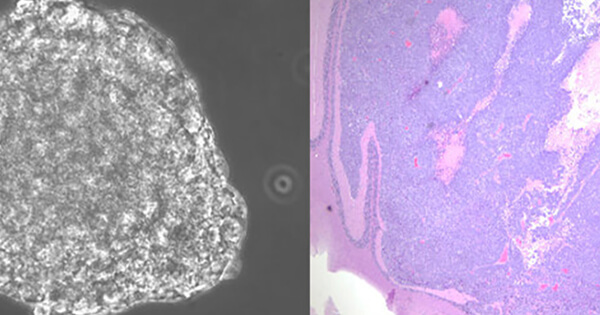 Improved Lab Model Developed For Studying Medulloblastoma National