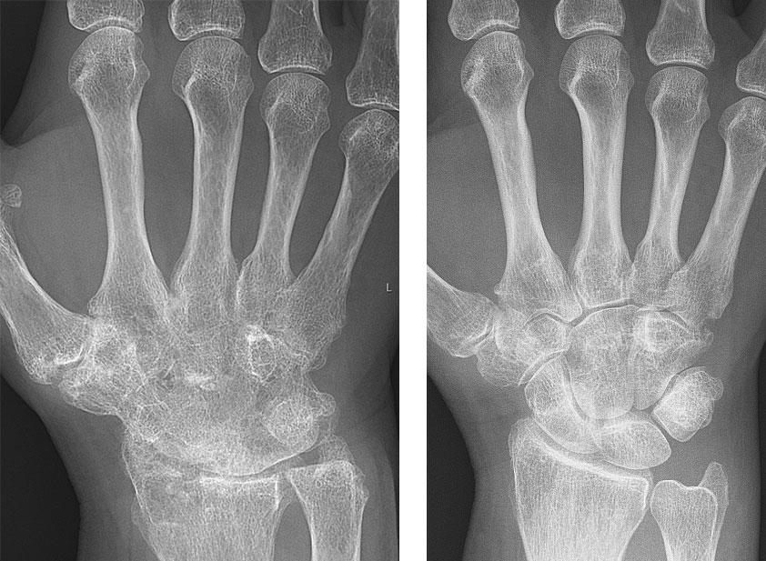 Before and after hand x-rays from a woman with rheumatoid arthritis.