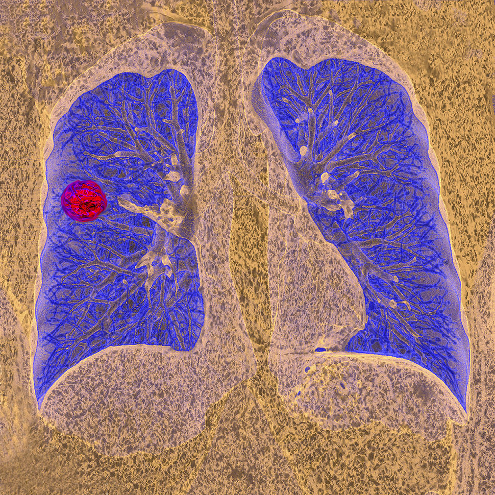 A CT scan of a person with lung cancer.