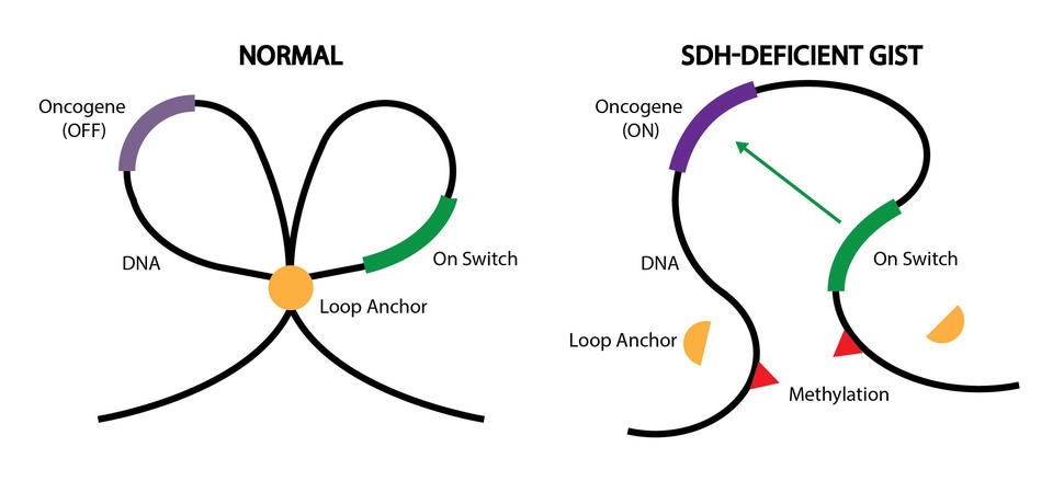 A graphic explaining epigenetic changes in normal cells and SDH-deficient GIST.