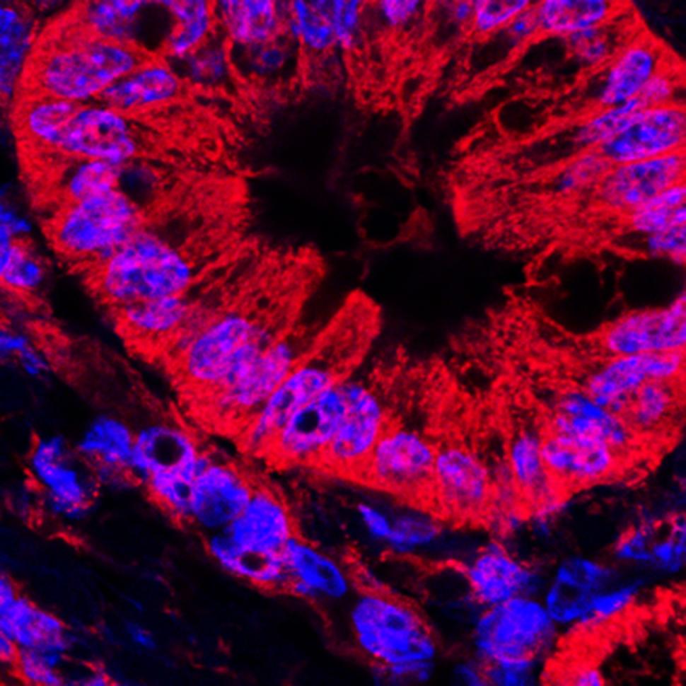 This image shows mitochondrial staining (red) and nuclear staining (blue) of abnormal pancreatic ducts from a mouse model of human pancreatic ductal carcinoma. 