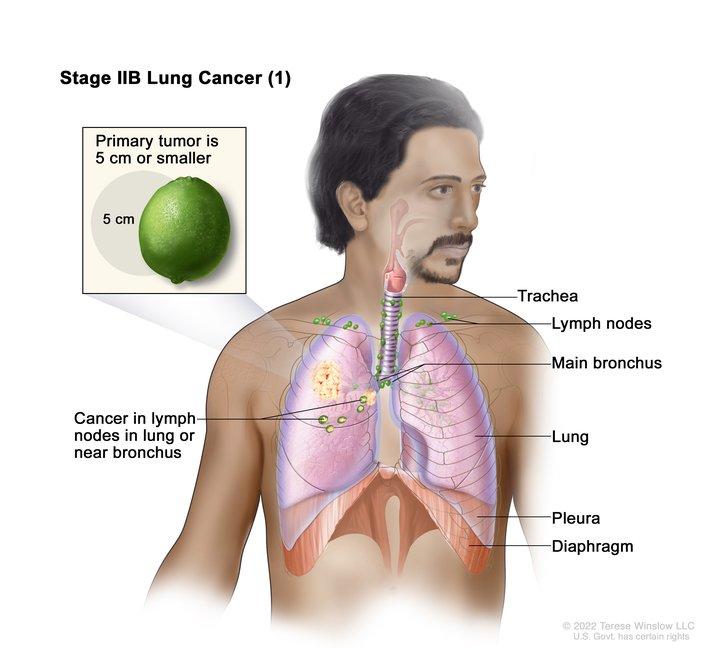 An anatomic illustration of stage 2b nonsmall cell lung cancer
