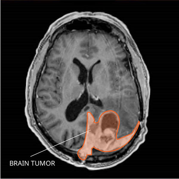 A meningioma in brain tissue seen in a slice from a magnetic resonance imaging (MRI) procedure.