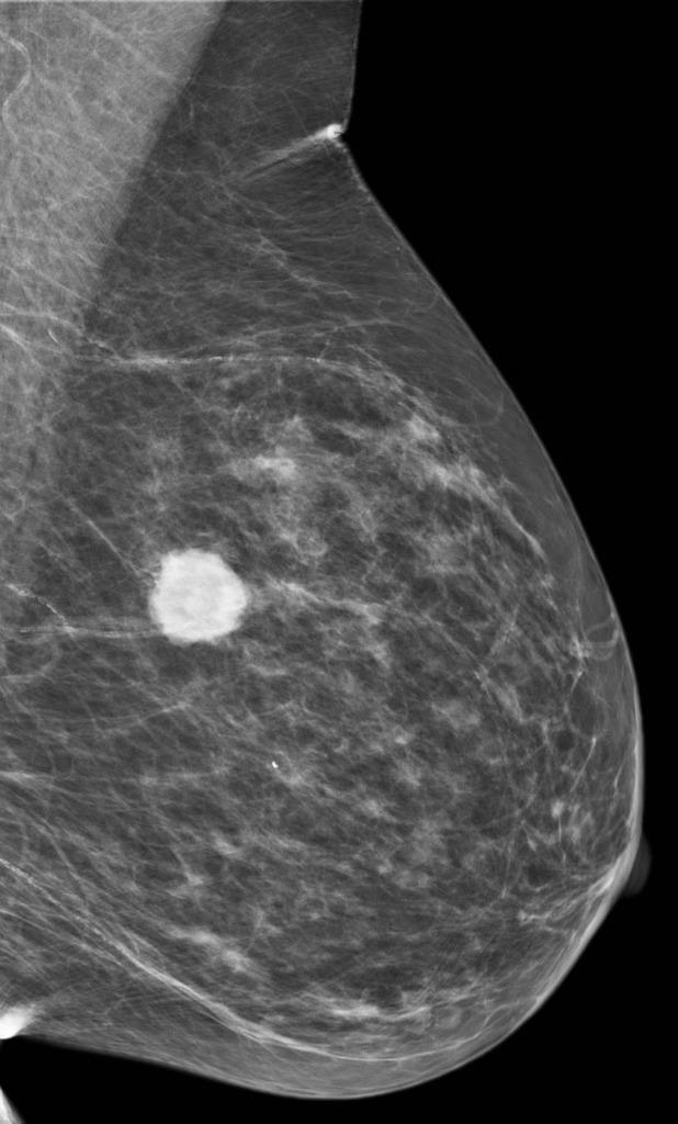 A mammogram of a breast showing a tumor in bright white against the normal breast tissue which appears grey. The tumor is dense and has both smooth, defined margins and spiculated edges.