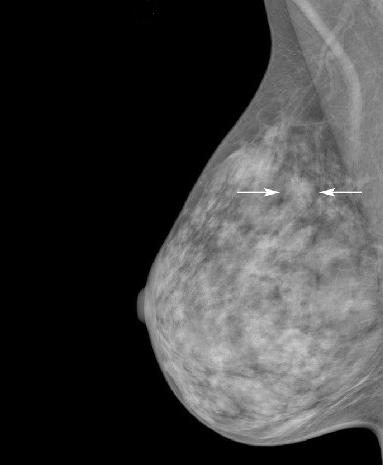 Una mamografía que indica con flechas una asimetría en la zona superior de la mama.