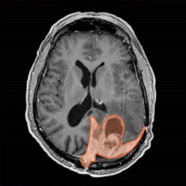 Resonancia magnética de encéfalo en la que se marca un meningioma en color naranja.
