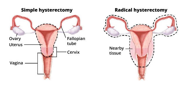 An anatomical illustration with a dotted line identifying the areas removed during simple and radical hysterectomies