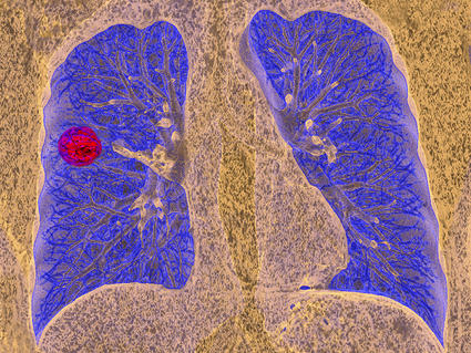 A CT scan of a person with lung cancer.