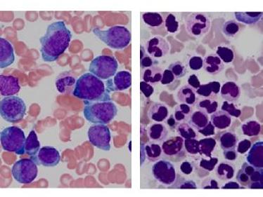 Pathology slides from a patient with acute myeloid leukemia that has relapsed (left) and after remission (right).