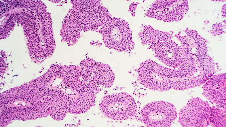 Microscopic section of a papillary urothelial (transitional cell) carcinoma, showing characteristic papillary structures with fibrovascular cores.