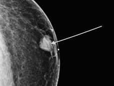 Mamografía diagnóstica muestra un tumor en el seno izquierdo de un paciente de sexo masculino.