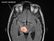 RM de glioma difuso de línea media en el cerebro.