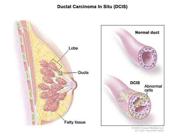 risk-of-breast-cancer-death-is-low-after-dcis-diagnosis-national