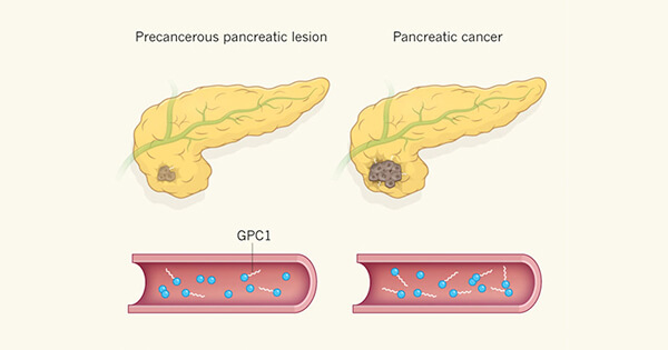 Possible Diagnostic Marker For Pancreatic Cancer - National Cancer ...