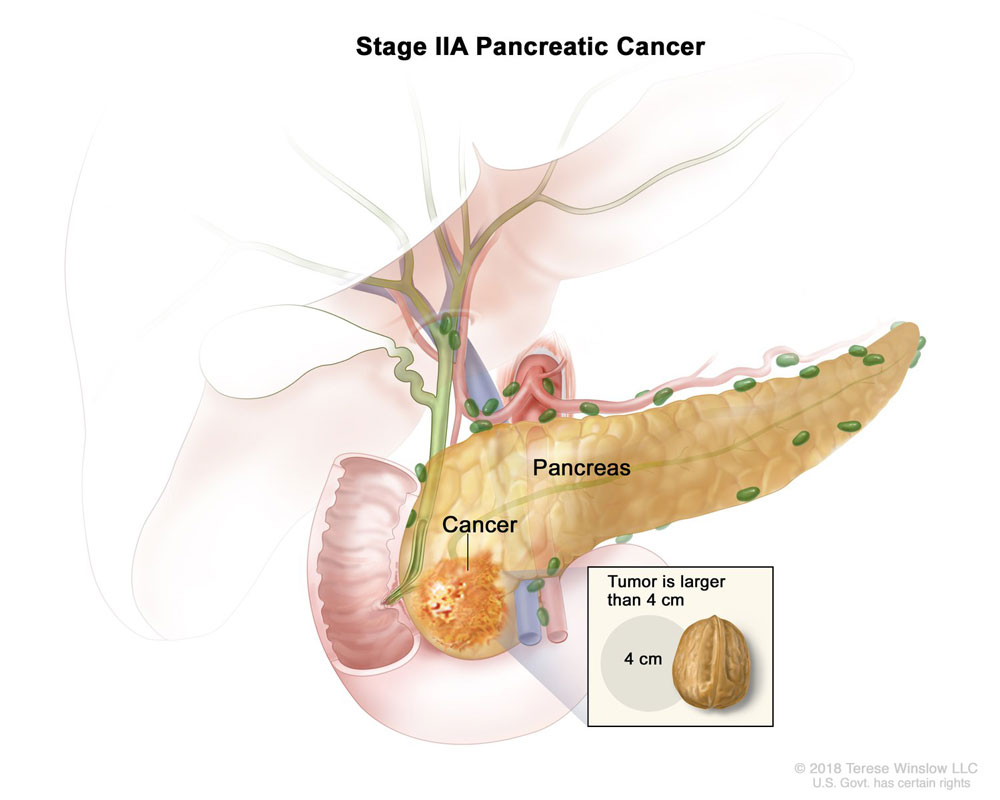 Introduction Of Cancer And Pancreatic Cancer