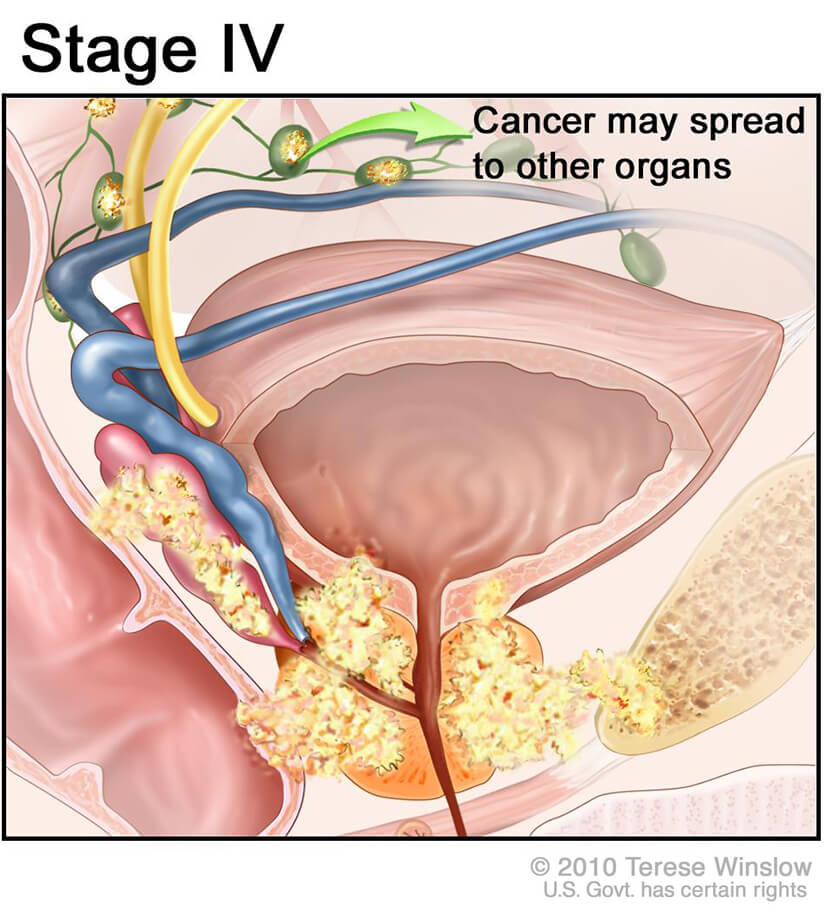 New Subtype Of Treatment Resistant Prostate Cancer National Cancer