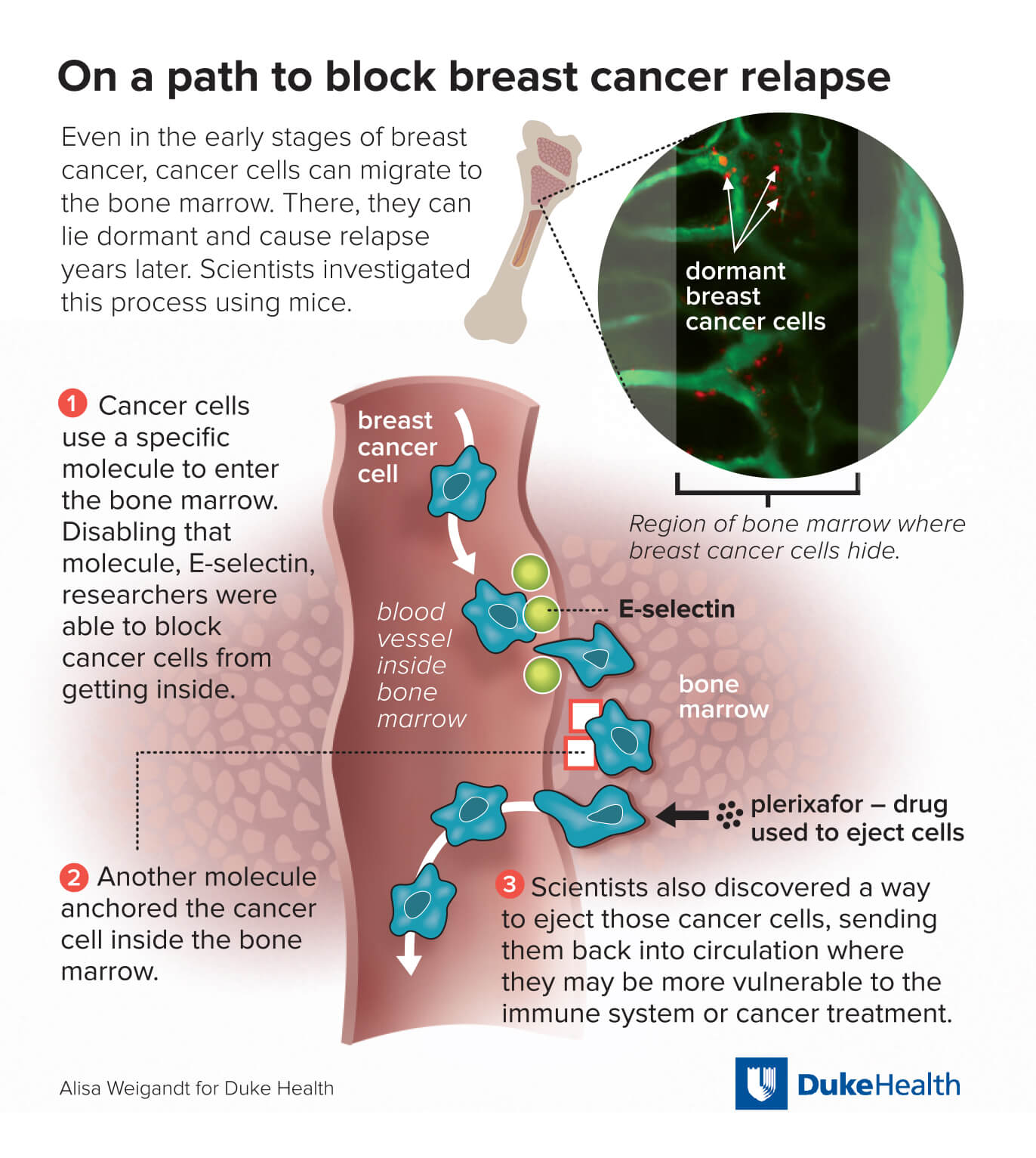 Cancer s Spread To Bone National Cancer Institute