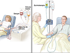 Un paciente recibiendo un trasplante de células madre