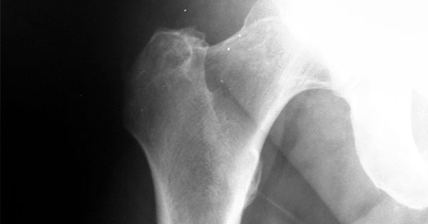 Radiation for Controlling Pain from Bone Metastases - National Cancer