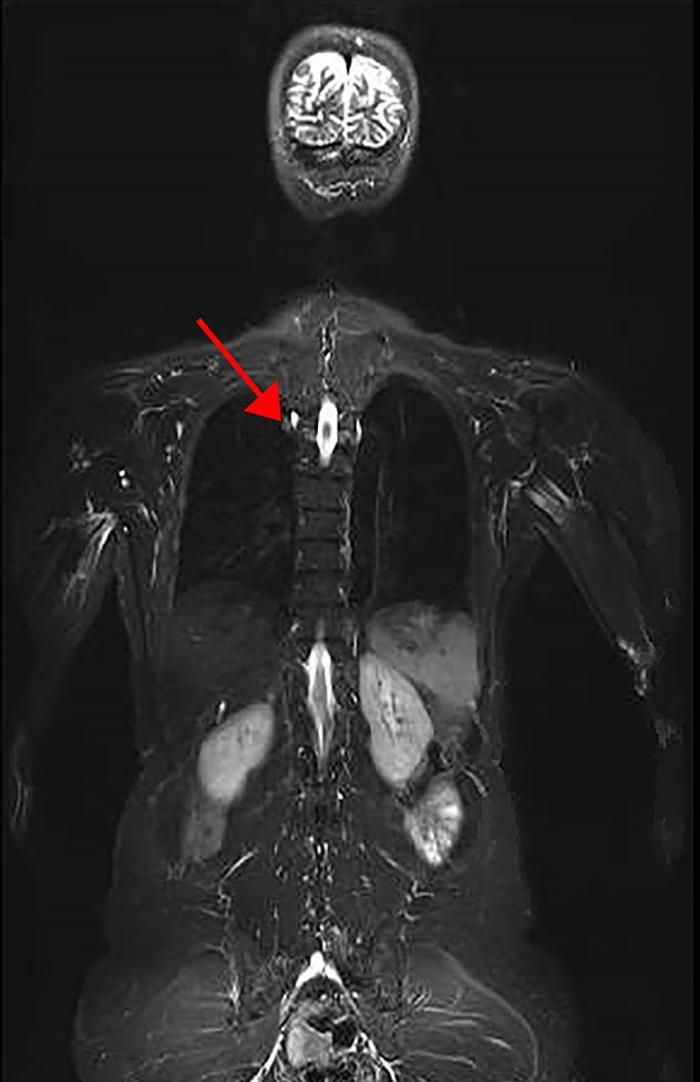 Cancer Screening Protocol for Patients with LiFraumeni