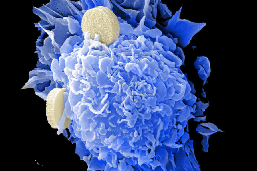 Nanotechnology Cancer Therapy and Treatment - NCI