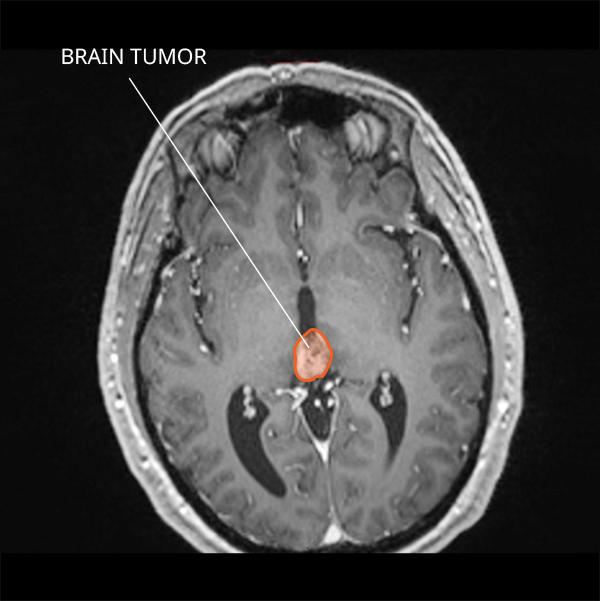 Cat Scan Brain Tumor