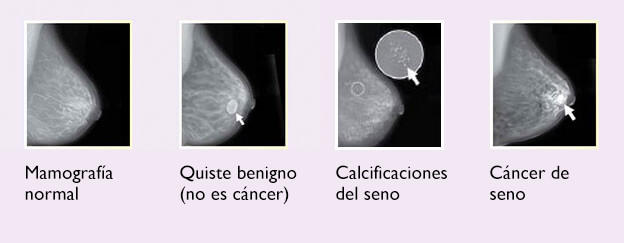 Significado de cambios y afecciones de los senos - NCI