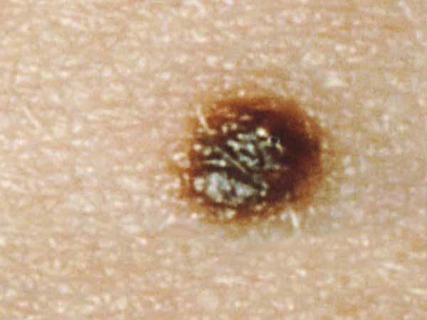 a mole with white dot