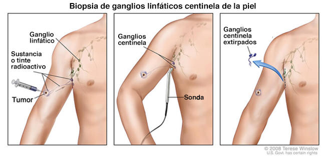 Cirugía de gangios linfáticos en cirugía de melanoma. - NCI