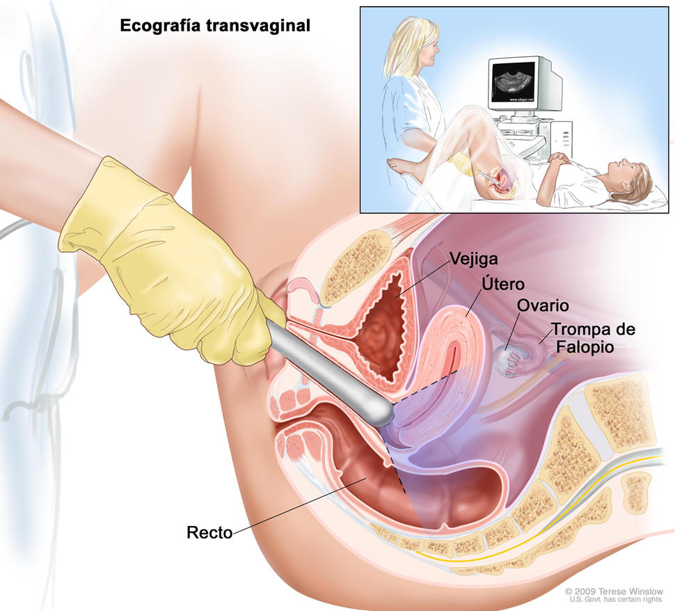 Mayores detalles sobre sangrado posmenopáusico y cáncer de endometrio - NCI