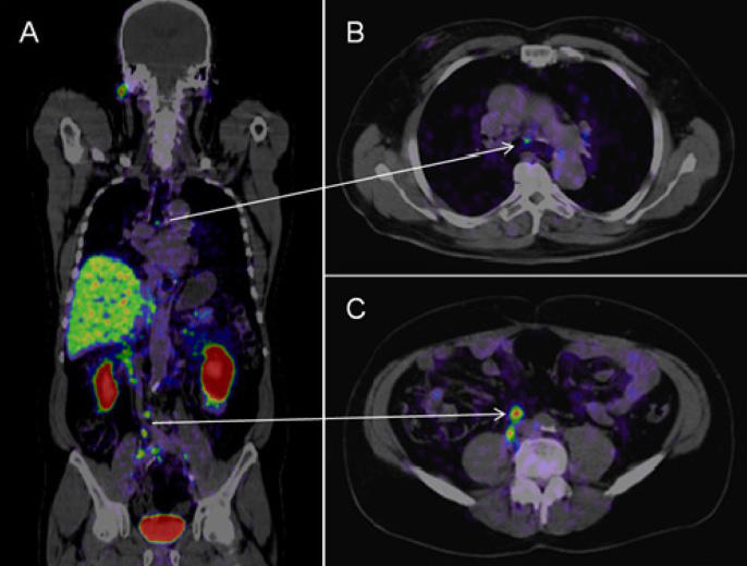Psma Pet Ct Accurately Detects Prostate Cancer Spread National Cancer Institute