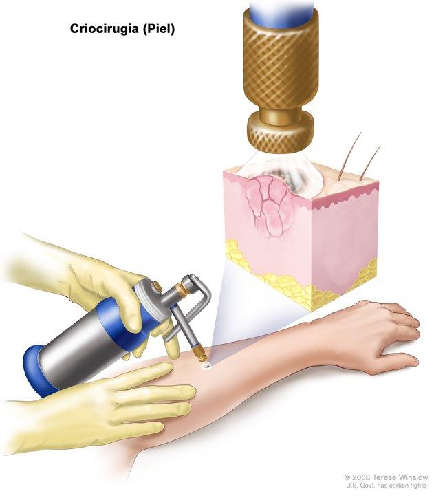El dibujo muestra un cilindro de metal pequeño con una boquilla，El instrumento que se usa para aplicar la crioterapia，apuntando a unárea normal en la parte super del braco de un paciente。 