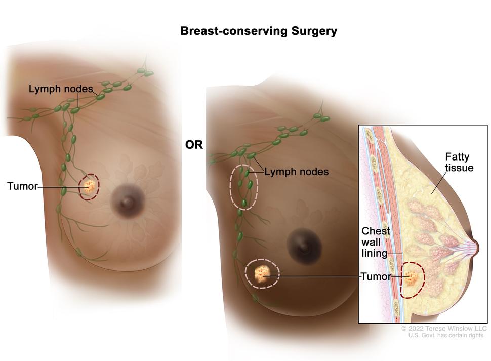 Early Breast Cancer May Not Carry High Risk : Shots - Health News