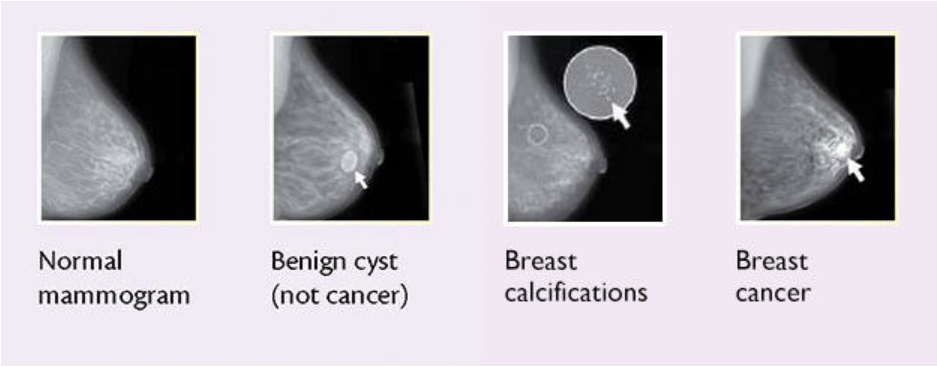 What It Means to Have Dense Breasts