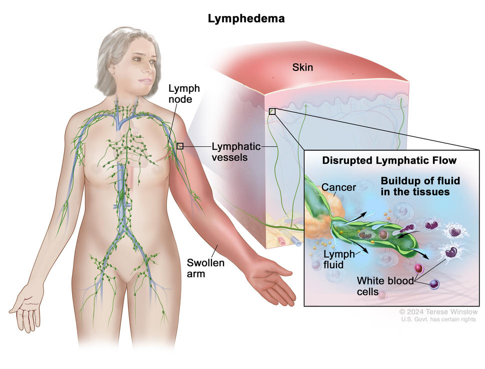 Lymphedema and Cancer Treatment - NCI