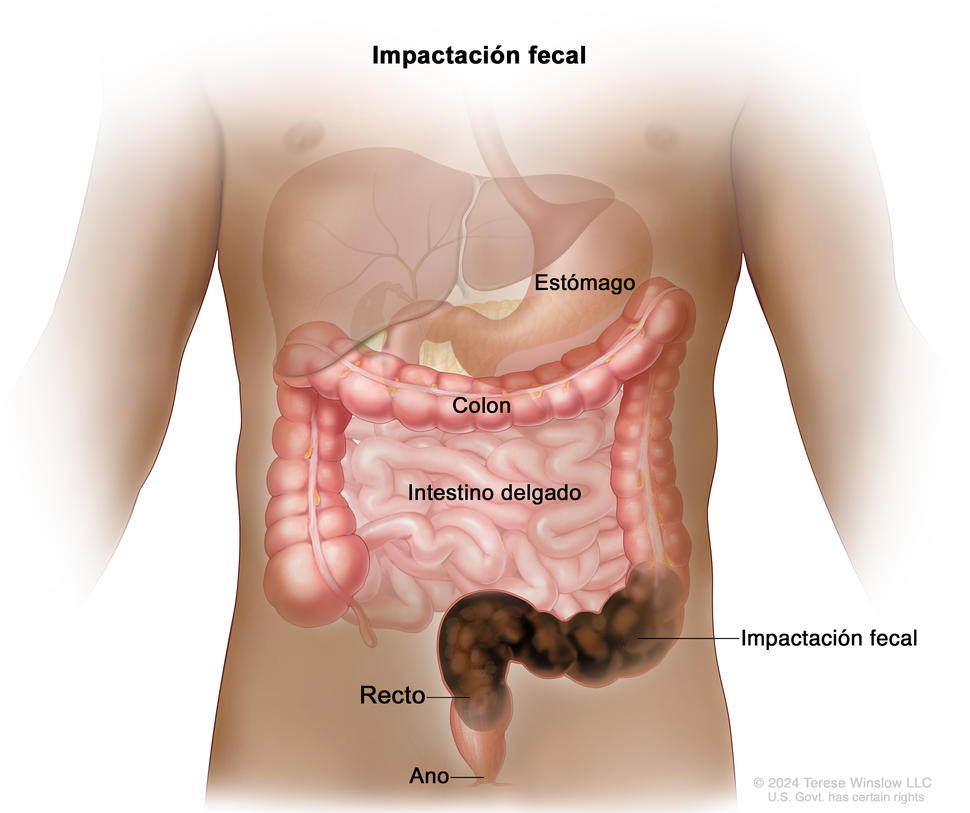 En el dibujo se muestra la anatomía del tubo digestivo de un ser humano, incluso el estómago, el intestino delgado, el colon, el recto y el ano; además, se observa la impactación fecal (heces retenidas) que bloquea el flujo de desechos a través del recto.