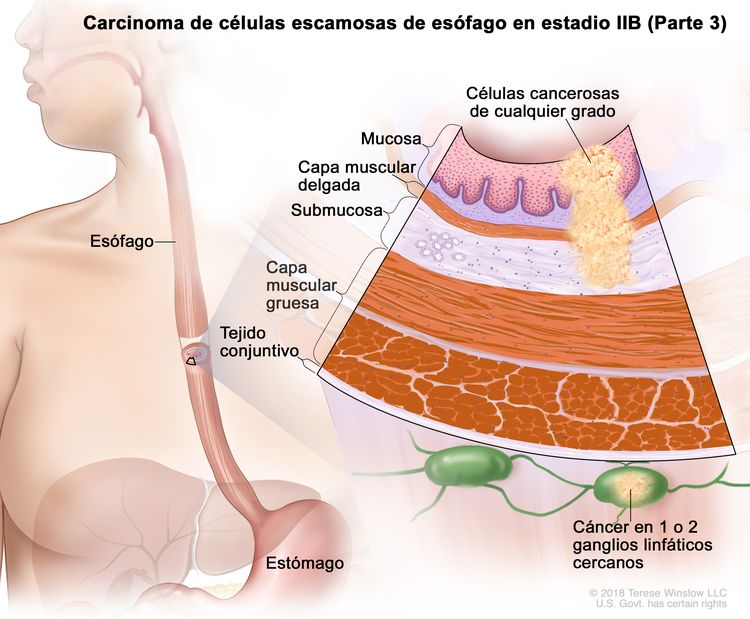 Ilustración anatómica del cáncer de esófago en estadio 2b, con un primer plano de ganglios linfáticos cercanos donde hay cáncer.