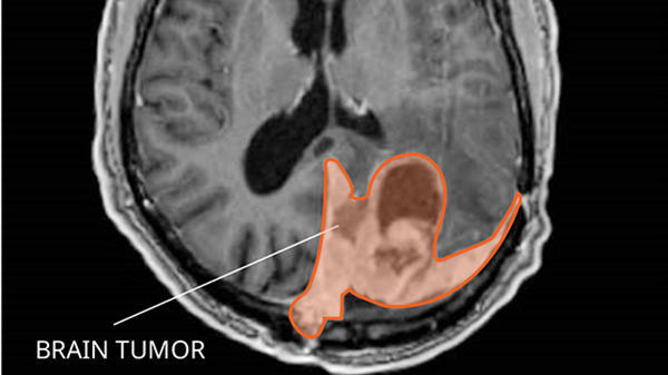 brain tumor pictures
