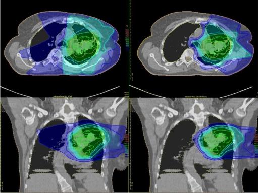 Rapid Radiation Therapy That Takes a Fraction of the Time > News > Yale  Medicine
