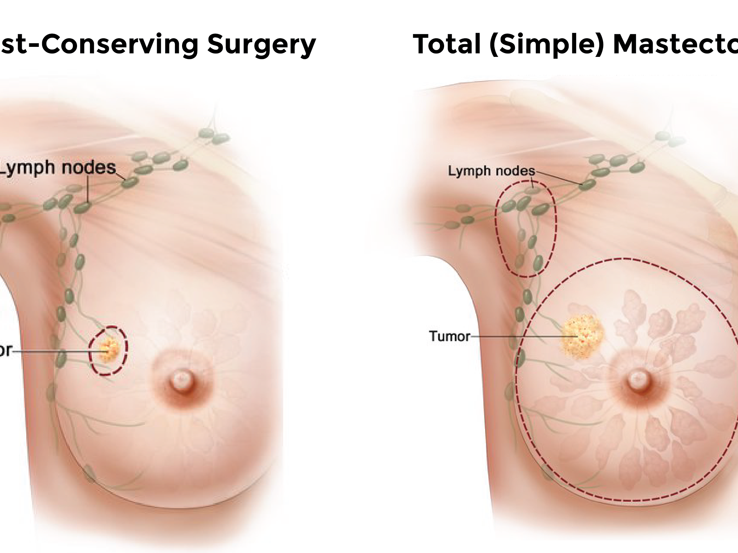 The clinical picture of the left breast at one-month post-surgery
