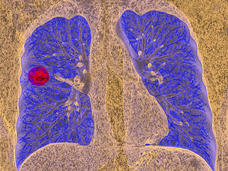 Una imagen de TC de una persona con cáncer de pulmón.