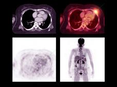 Tomografía por emisión de positrones con tomografía computarizada (TEP-TC) de un tumor que volvió en una persona con cáncer de pulmón.