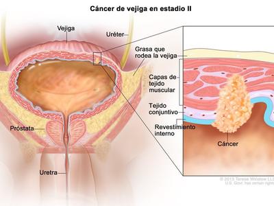 Ilustración del cáncer de vejiga en estadio II, que también se llama cáncer de vejiga con invasión muscular. En un recuadro se observa el cáncer en el revestimiento interno de la vejiga y en la capa de tejido conjuntivo y las capas musculares de la vejiga.