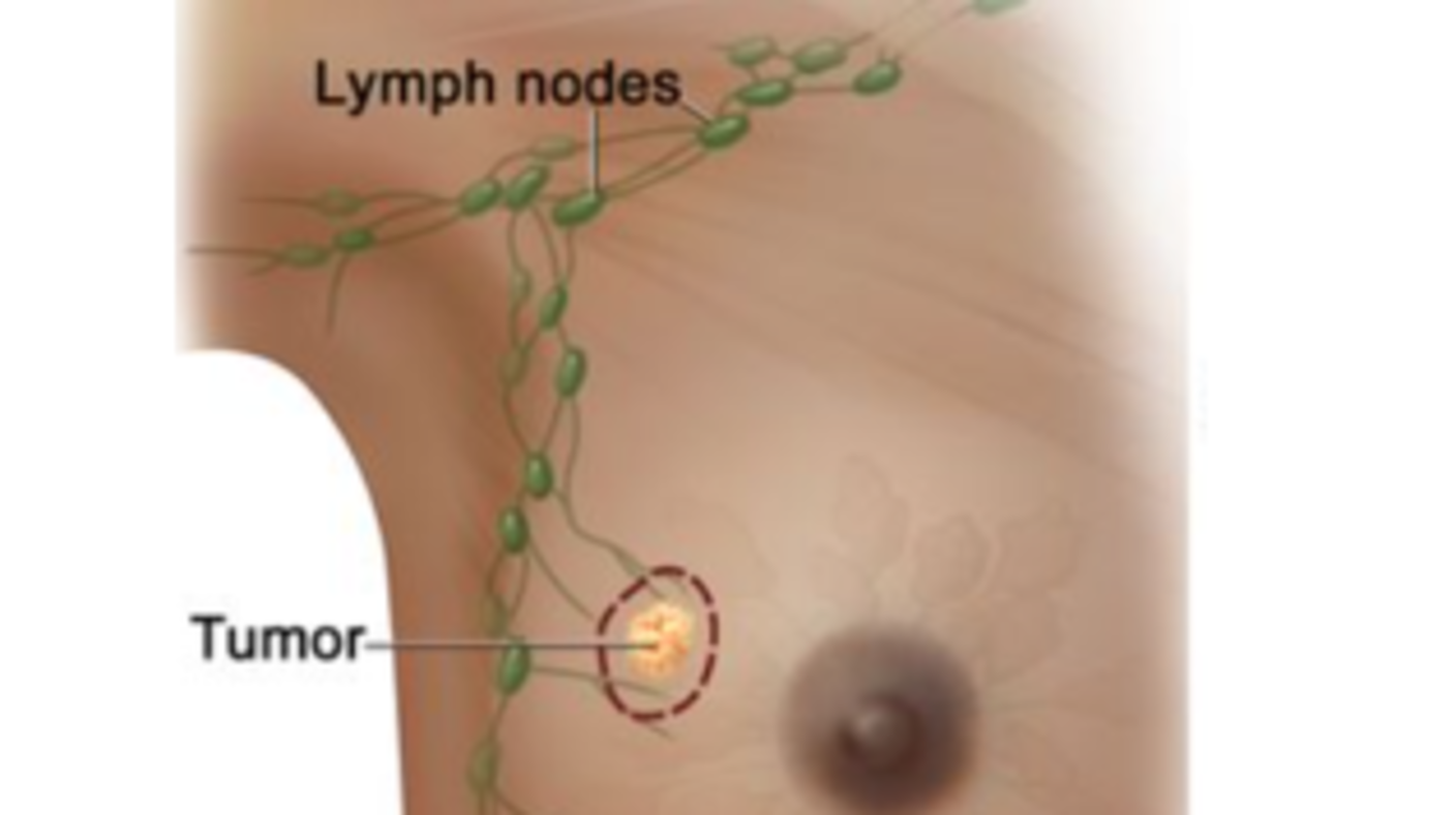 An illustration of a small tumor in a breast and nearby lymph nodes in the armpit.